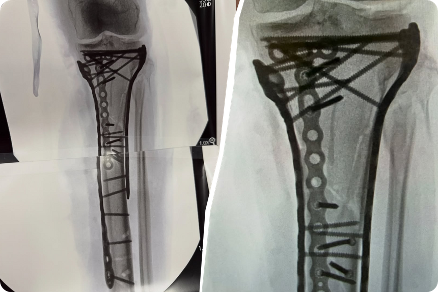 Нога Линдси Вонн